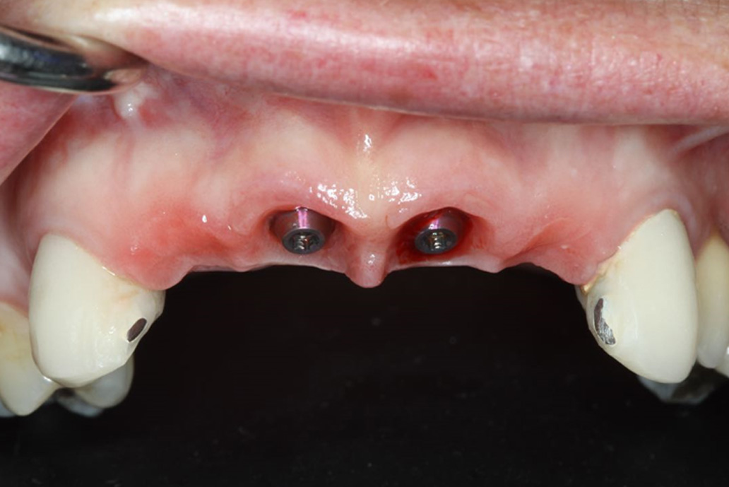 Multiple tooth replacements | Dr. Paul van Zyl